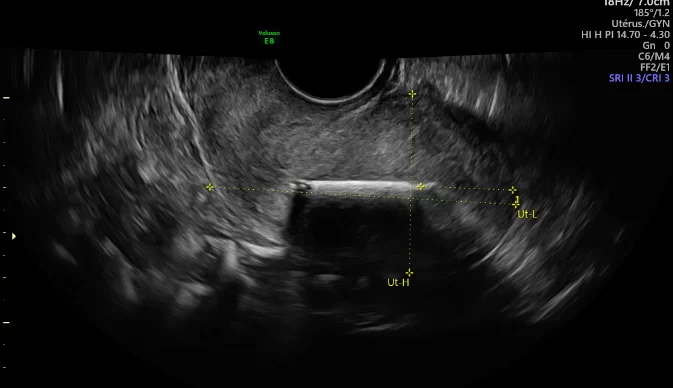uterus-5